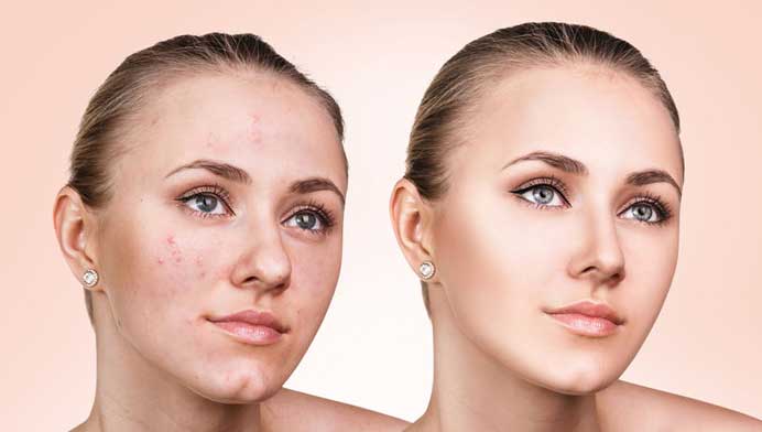 acne-behandeling