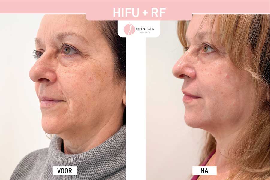 Hifu voor na