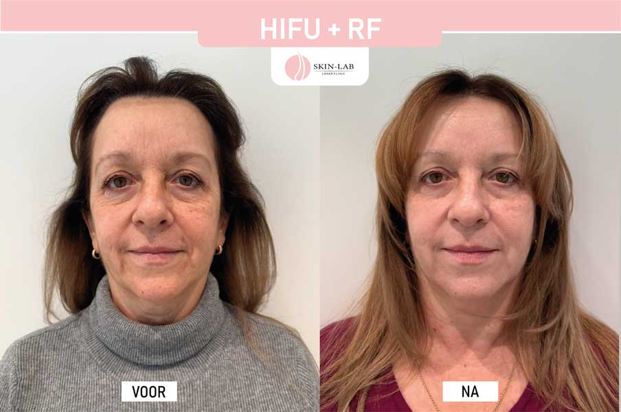 Hifu Voor Na