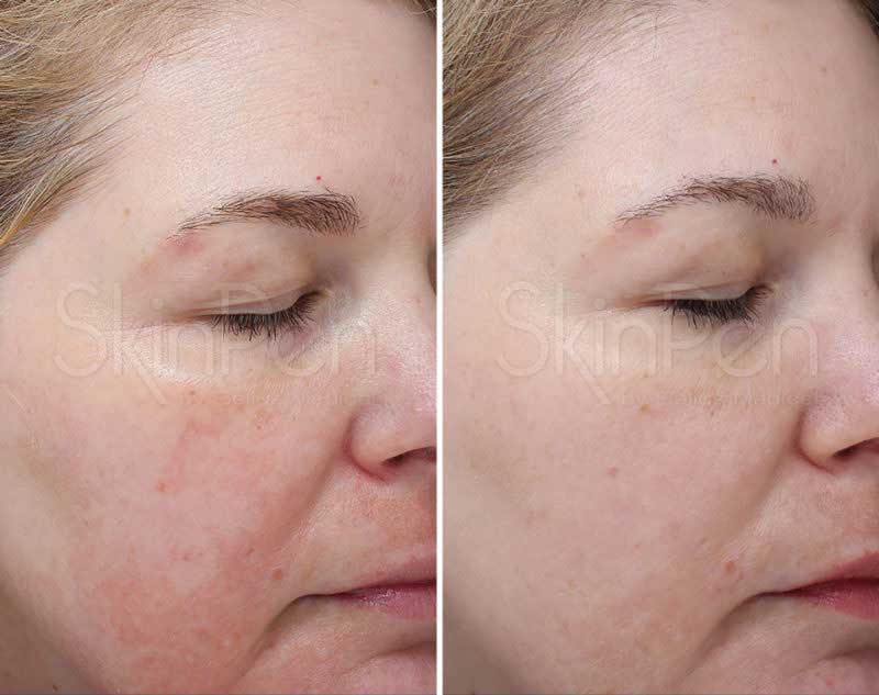 Skinpen-voor-na-gezicht Skinpen gezichtsbehandeling voor en na