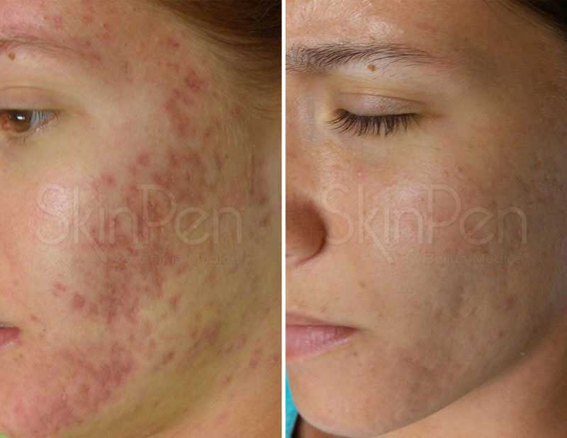 skinpen-voor-na SkinPen Voor Na
