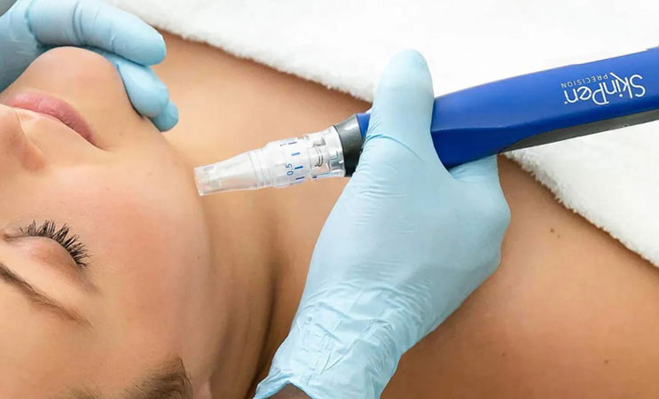 SkinPenMainContentBlock1 Acne SkinPen Microneedling