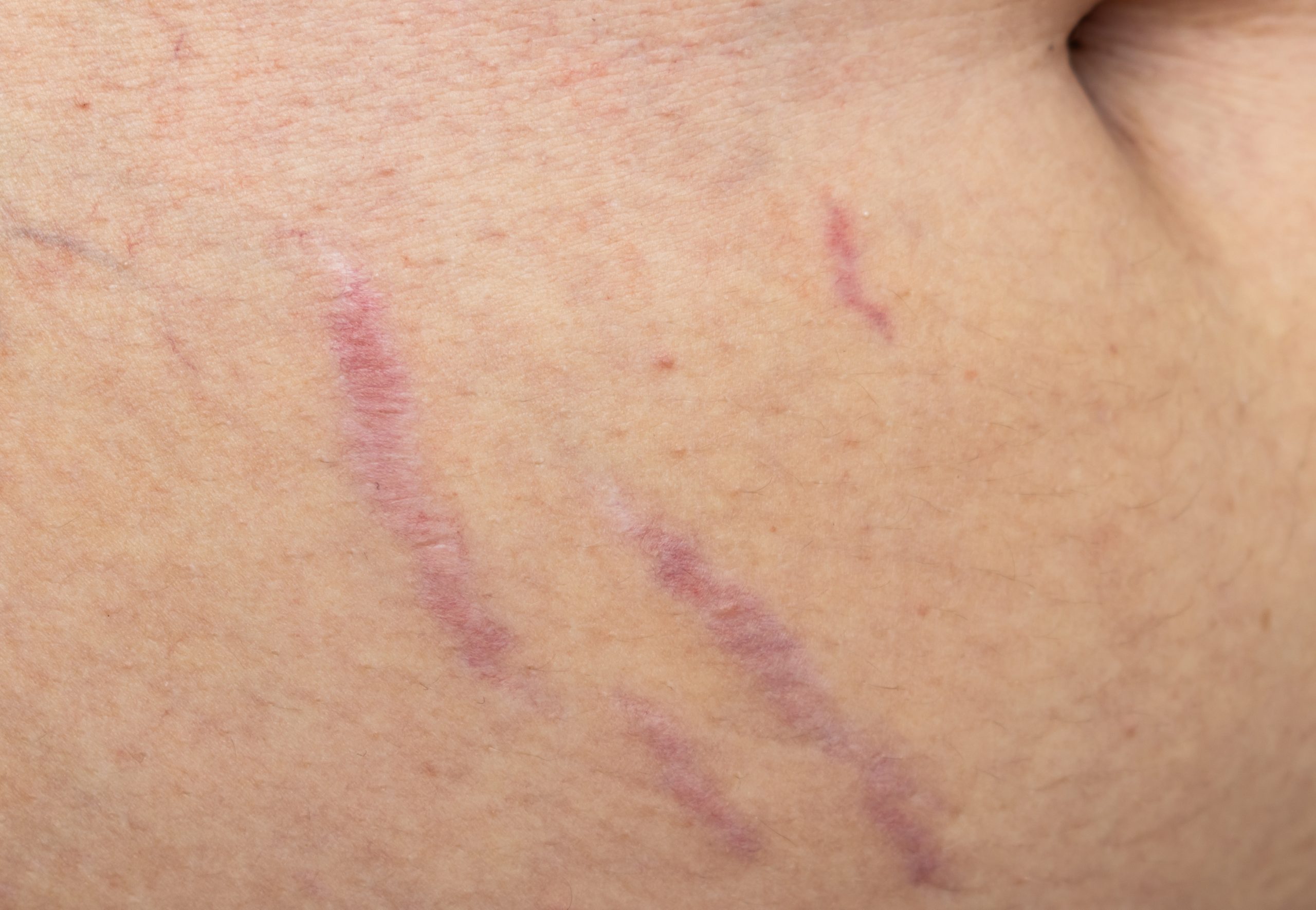 Onze aanpak huidverbetering