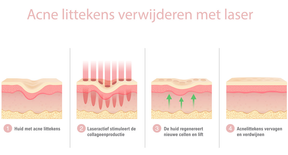 hoe-behandelen-wij-acne-littekens acne littekens verwijderen