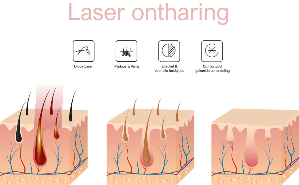 Hoe werkt laserontharing