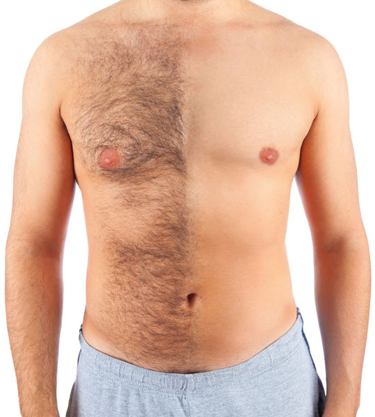 laserontharing borst man