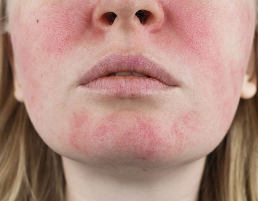 Rosacea