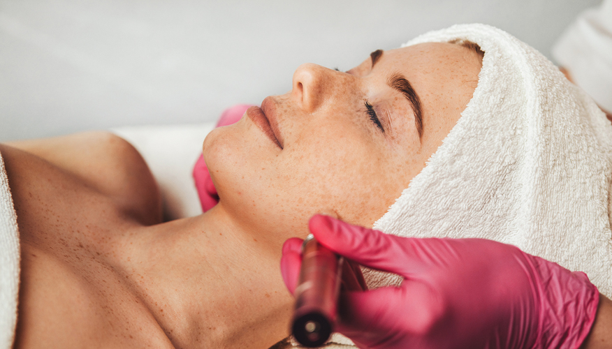 Melasma vrouw behandeling