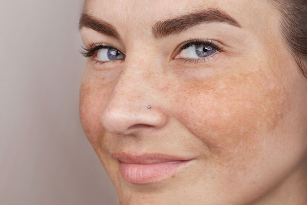 Wat is Melasma