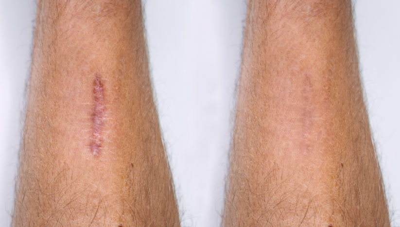 littekens benen man
