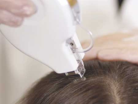 Mesotherapy-hair Mesotherapy hair