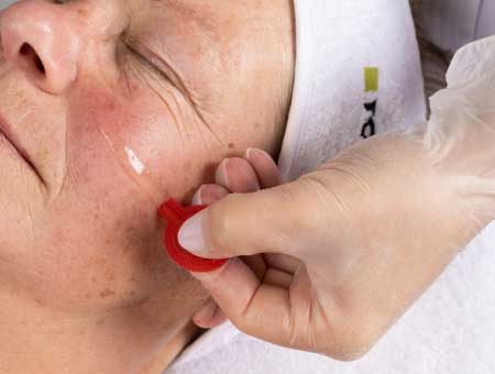 Mesotherapy-treatment Mesotherapy skin treatment